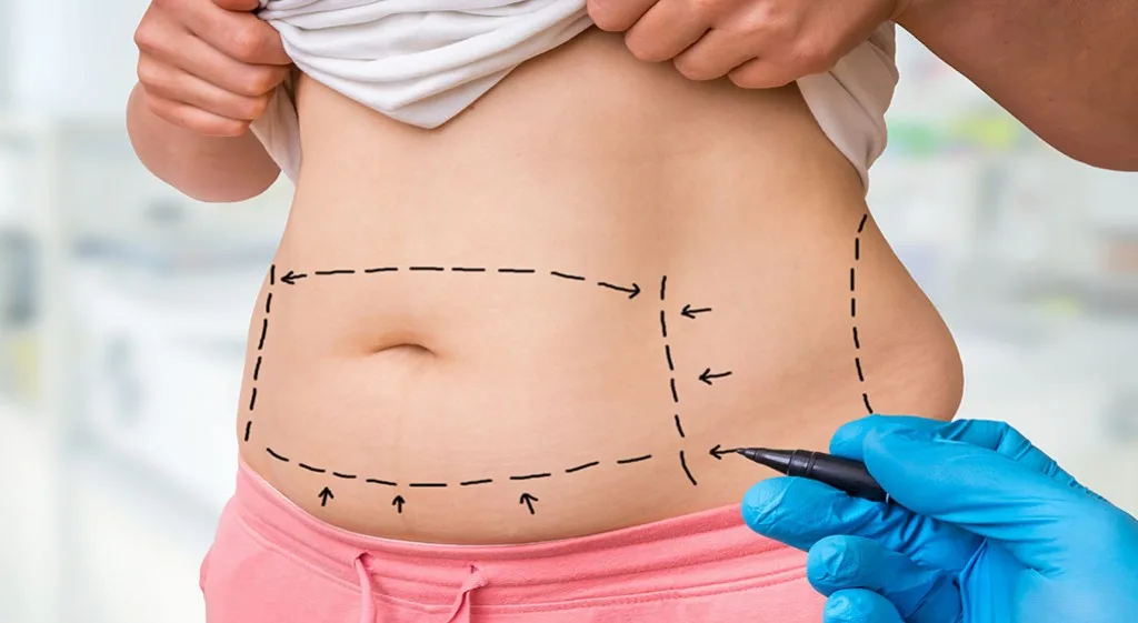 Liposukcja