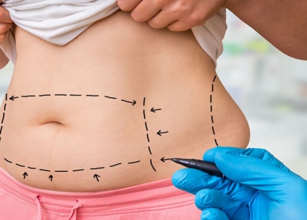 Liposukcja