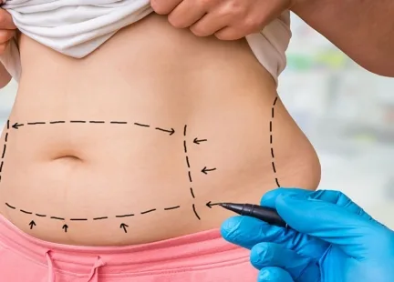 Liposukcja