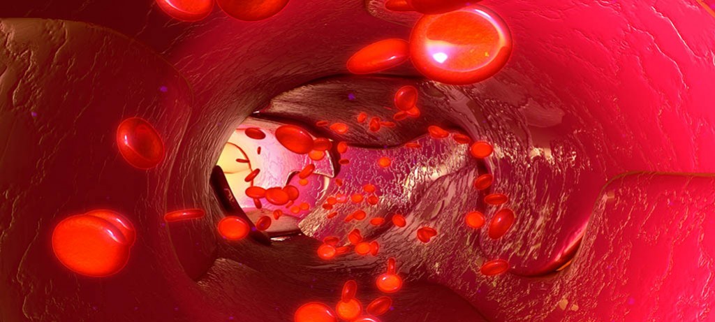 Wielopoziomowa choroba tętnic