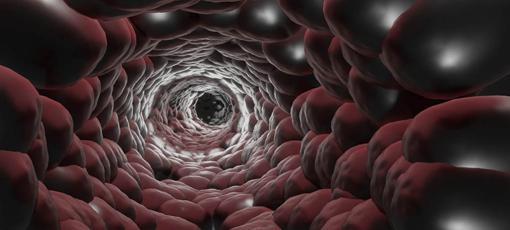 Olbrzymiokomórkowe zapalenie tętnic