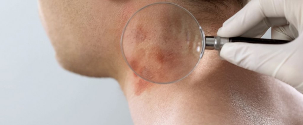 ŁUSZCZYCA – krępujący problem