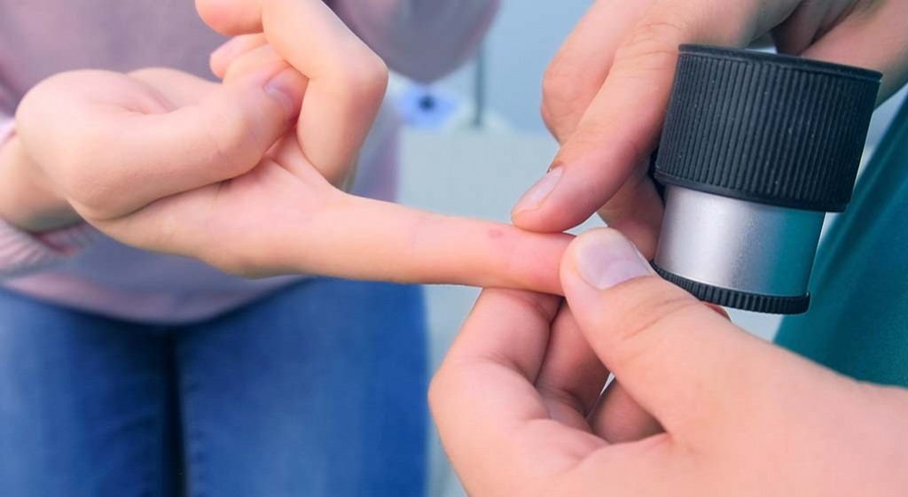 Kurzajki – naturalne metody leczenia