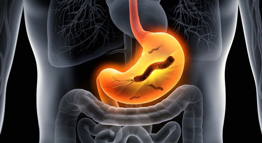 Helicobacter pylori – przebiegła bakteria