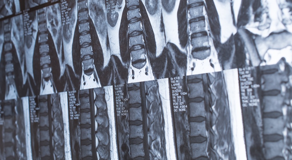 Budowa i funkcje krążka międzykręgowego (dysku)