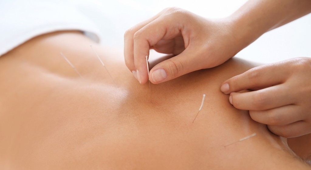 Akupunktura – w czym może pomóc