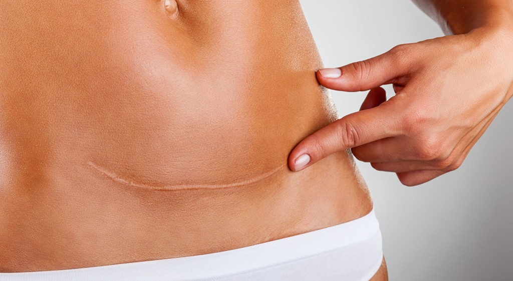 Jak pomóc w regeneracji ran pooperacyjnych