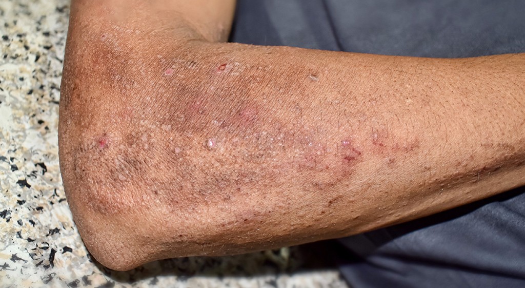 Pelagra – zapomniana i groźna choroba