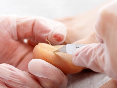 Wrastający paznokieć