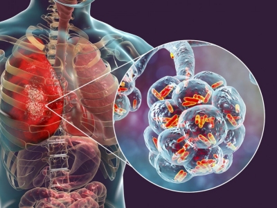 Zapalenie płuc – wprowadzenie