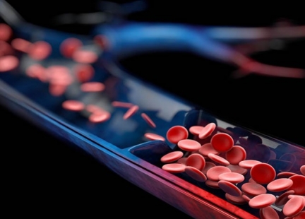 Zakrzepowe zapalenie żył powierzchniowych