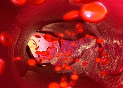 Wielopoziomowa choroba tętnic