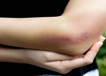 Zespół Ehlersa i Danlosa – postać naczyniowa