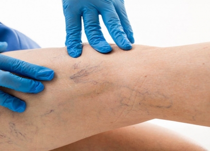 Przewlekła niewydolność żylna