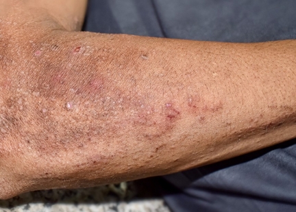 Pelagra – zapomniana i groźna choroba